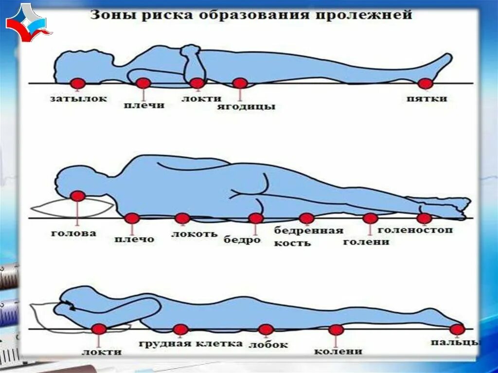 Места образования пролежней. Зоны риска образования пролежней. Места появления пролежней. Места образования пролежней на спине.