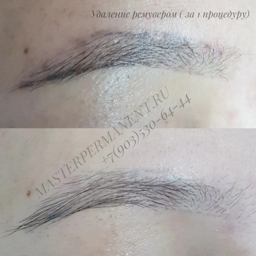 удаление кислотным ремувером. ремувер для выведения перманентного макияжа. брови ремувером. удаление кислотным ремувером. удаление татуажа ремувером.