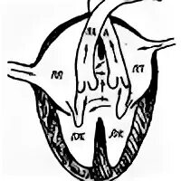 Внутрисердечная гемодинамика. Атриовентрикулярный канал. Неполный атриовентрикулярный канал. Внутрисердечная гемодинамика в первой фазе.