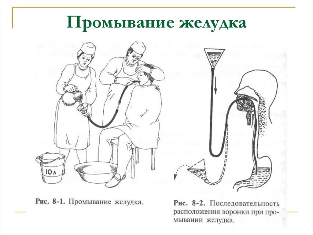 Зондовые манипуляции. Промывание желудка зондовым способом алгоритм. Промывание желудка толстым зондом алгоритм. Техника промывания желудка зондом алгоритм. Желудочный зонд для промывания желудка техника.