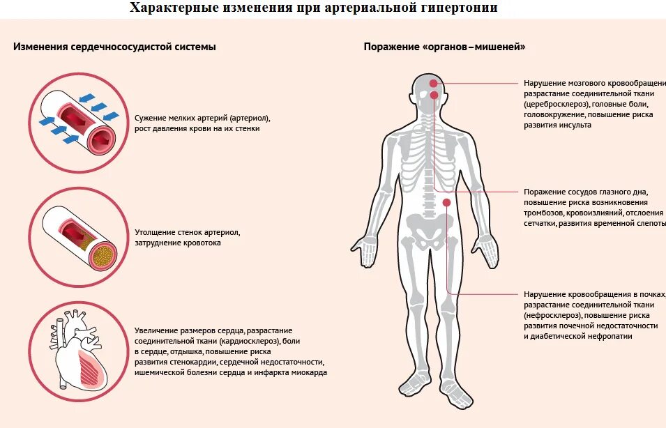 Симптомы артериальной гипертонии