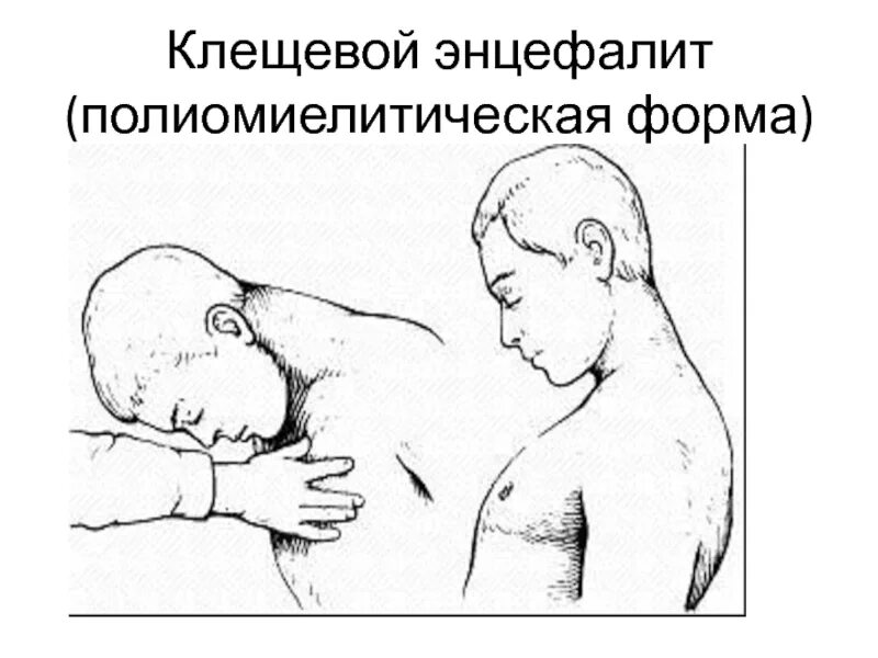 Первый симптом энцефалита. Клинические формы клещевого энцефалита неврология. клещевой энцефалит парез. клещевой энцефалит классификация клинические формы. очаговая форма клещевого энцефалита.