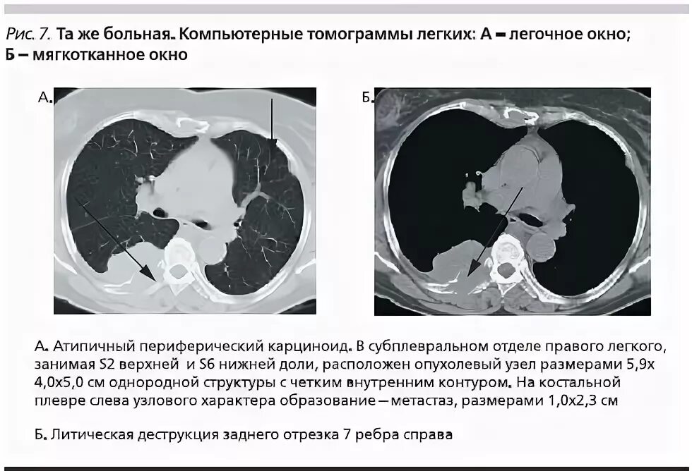 Субплевральные отделы легких