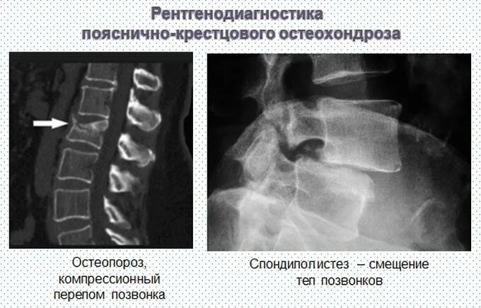 Остеопороз костей позвоночника. Остеопороз позвонка на кт. Компрессионный перелом позвоночника тн12. Остеопороз костей позвоночника рентген. Остеопороз позвоночника рентген.