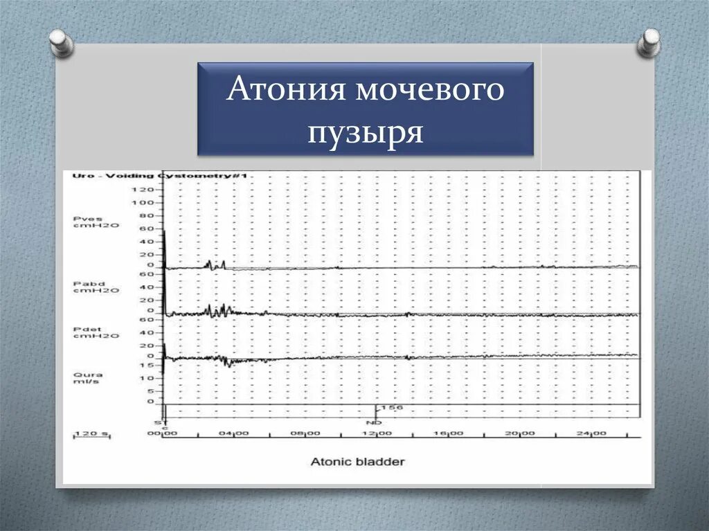 Лечение мочевого пузыря у мужчин лекарства. Послеоперационная атония мочевого пузыря. Препараты при атонии мочевого пузыря. Атония детрузора мочевого пузыря.