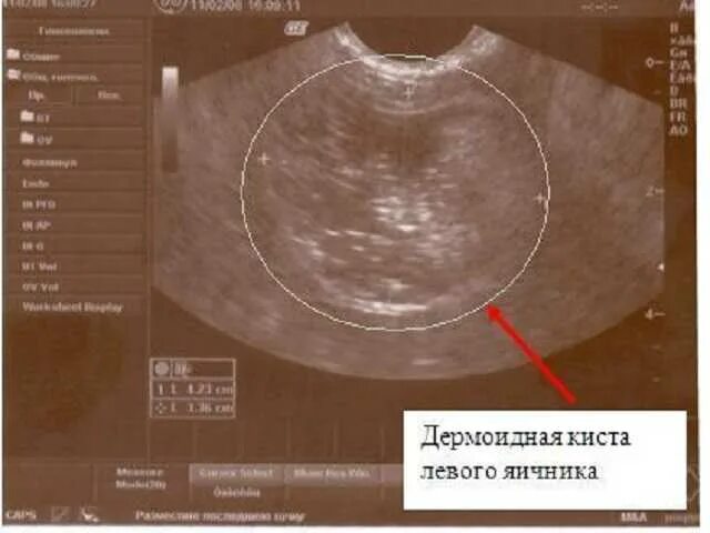 Дермоидная киста яичника на УЗИ. Дермоидные кисты яичников на УЗИ. Дермоидная и эндометриоидная киста яичников. Фолликулярная киста яичника макропрепарат. Киста размеры для операции