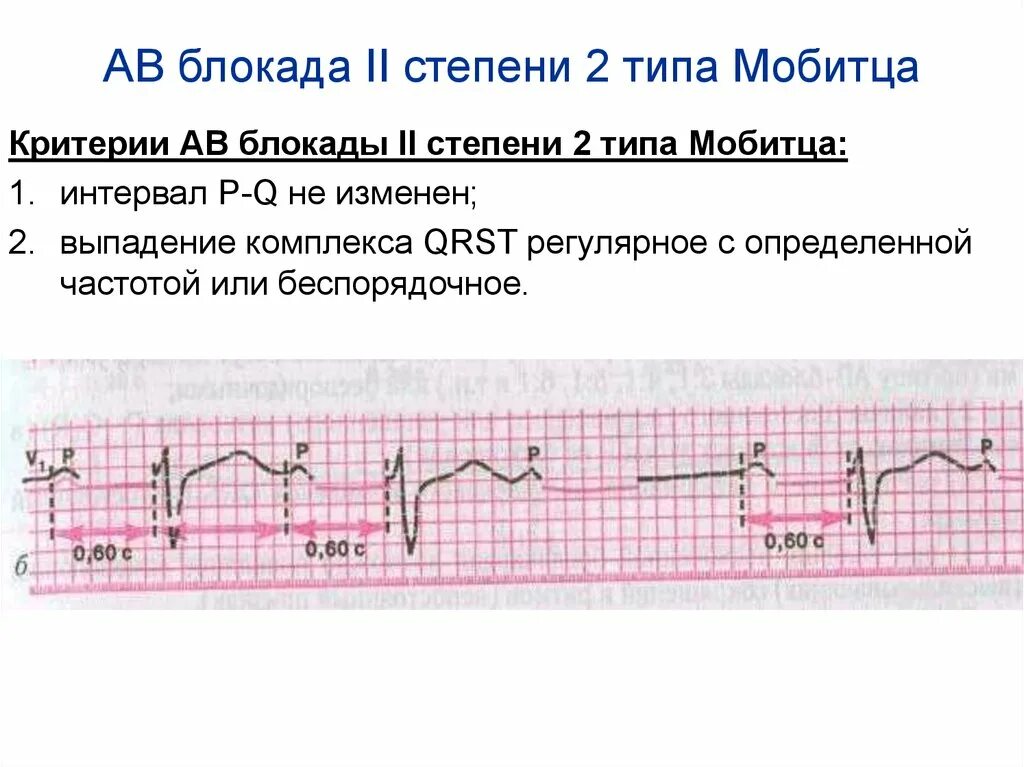 Атриовентрикулярная блокада 2. ЭКГ критерии АВ блокады 2 степени Мобитц 2. ЭКГ критерии АВ блокады 2 степени Мобитц 1. Av блокада 2 степени Мобитц 2 на ЭКГ. АВ блокада II степени Тип Мобитц II.