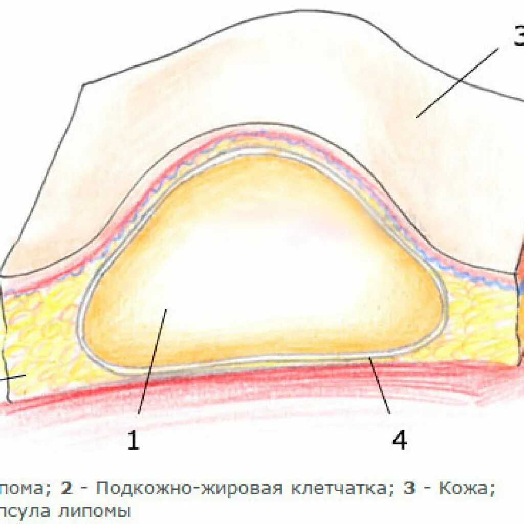 Жировик подкожный строение. Опухоль в капсуле