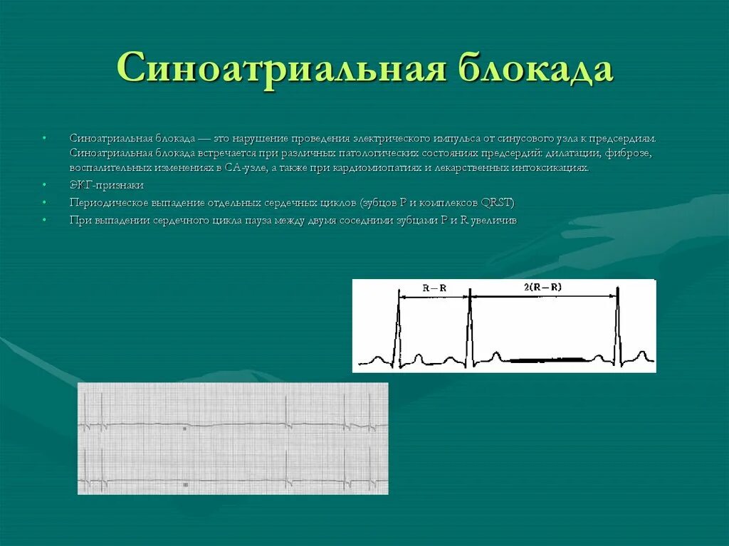Са-блокада 2 степени 2 на экг. Синоатриальная блокада презентация. Блокада синусового узла. Синоаурикулярная блокада 2 степени. Синоатриальная блокада 2 на экг.