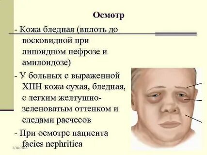 Почечное лицо