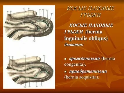 Косая паховая грыжа