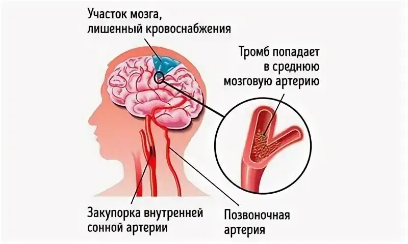 Инсульт в правой гемисфере