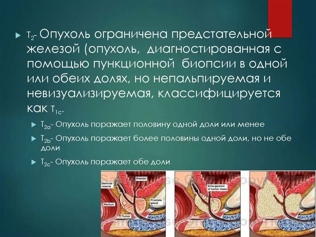 Простата это железа. Новообразование предстательной железы. Отек предстательной железы. Объемное образование предстательной железы.