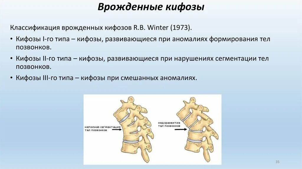 Врожденная аномалия развития позвоночника. Врожденная деформация позвоночника. Классификация врожденных кифозов.