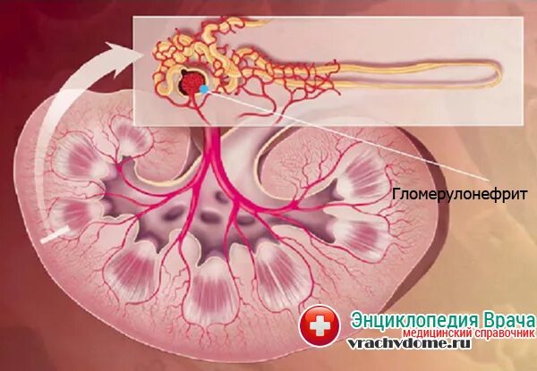 Гломерулонефрит почечный клубочек. Клубочки почек гломерулонефрит. Почечные клубочки гломерулы. Поражение клубочков почек