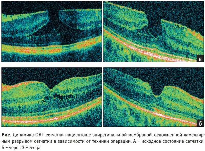 Ламеллярный разрыв сетчатки глаза. Эпиретинальная мембрана сетчатки. Ламеллярный разрыв макулы. Макулярный разрыв после операции