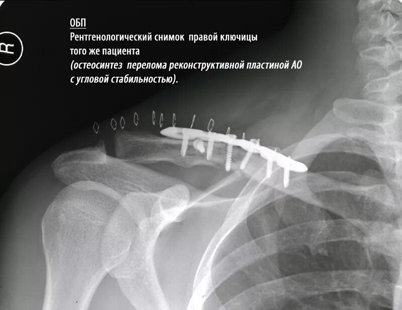 Вколоченный перелом ключицы. Репозиция перелома ключицы. Снимок перелома ключицы со смещением. Костная мозоль после перелома ключицы. Несросшийся перелом ключицы.