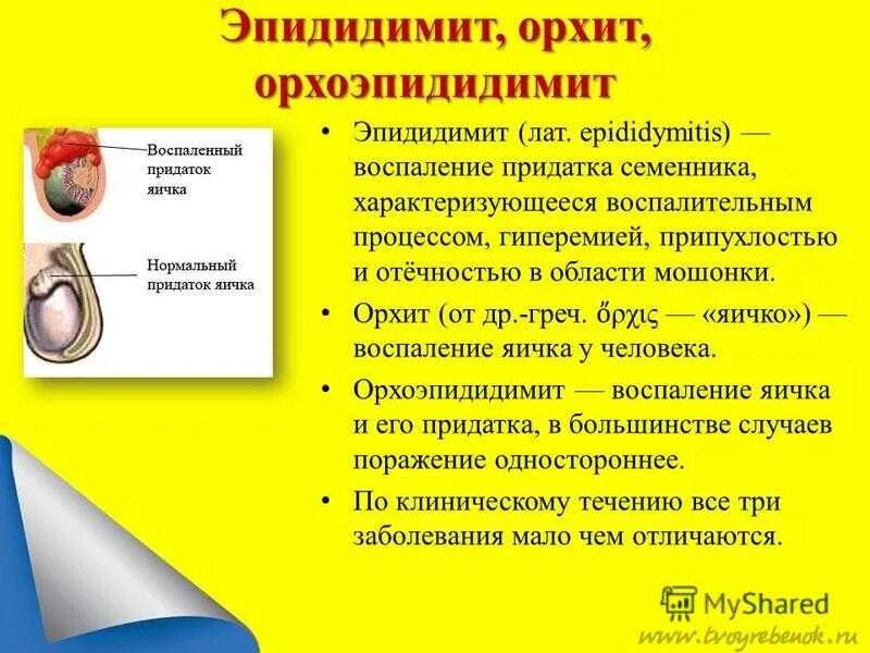 Воспаление придатка яичка симптомы. Эпидидимит, орхит, орхоэпидидимит. воспаление яичка симптомы. орхит (воспаление яичка).