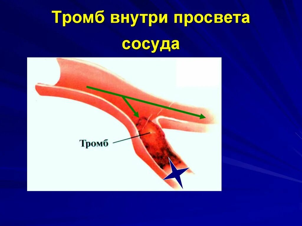 Тромб в Просвете сосуда. Красный тромб в Просвете сосуда. Основной тромб