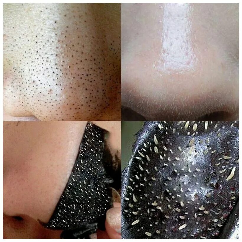 Очистка лица от черных точек и прыщей. Ланбена Blackhead Remover Mask. LANBENA Blackhead Remover Mask черная маска.