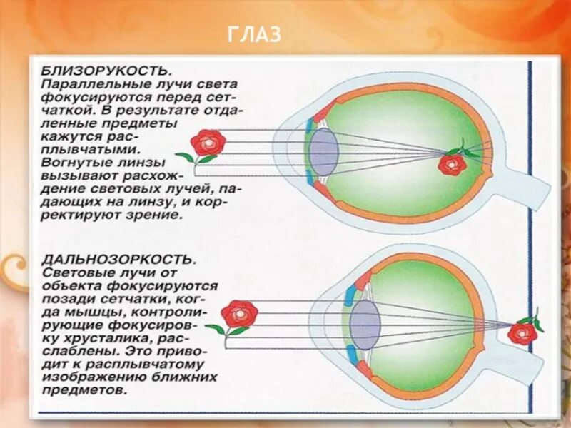 Дополните предложения изображение в близоруком глазу фокусируется