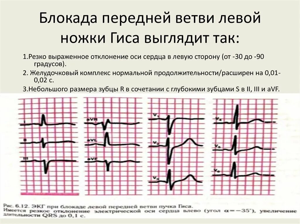 Блокада передней верхней ветви