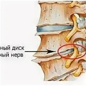 Остеофиты позвоночника что