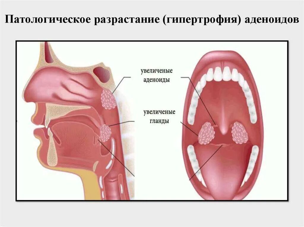 Гипертрофия глоточной миндалины аденоиды. Гипертрофия аденоидов и небных миндалин 2 степени. Гипертрофия глоточной степени. Гипертрофия аденоиды 2 степени. Степени гипертрофии небных миндалин.