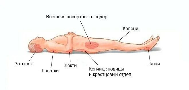 Пролежни в положении на боку. Пролежни места образования пролежней. места проявления пролежней. зоны риска образования пролежней. схема пролежни локализация.