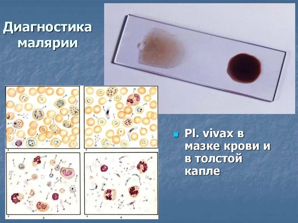 Мазок крови при выявлении патологии что это. Плазмодии малярии в толстой капле крови. Малярийный плазмодий мазок. Микроскопия толстой капли крови при малярии. Исследование толстой капли крови на малярию.