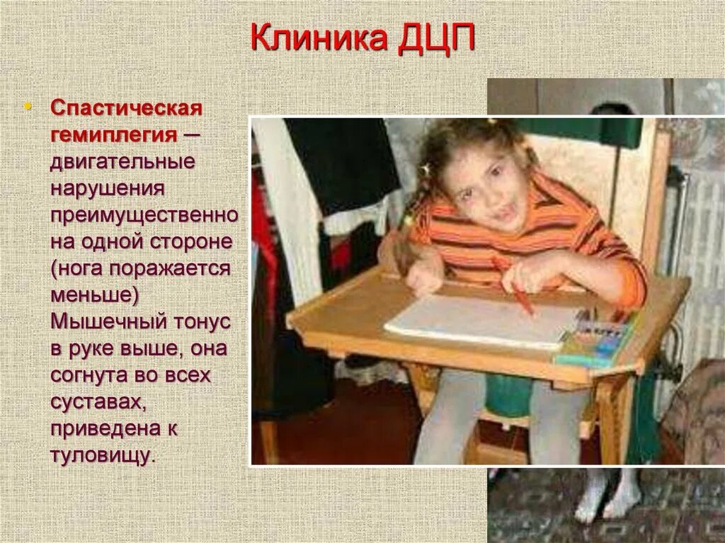 Дцп сообщение. Дети с дцп.