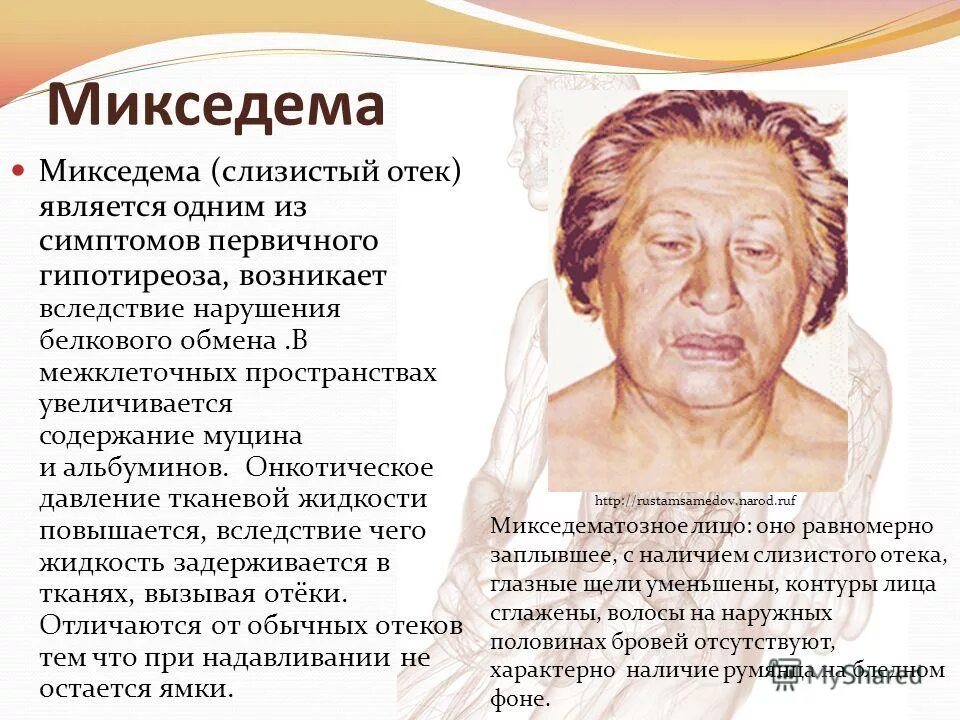 Гормональные отеки. Микседема гипотиреоз этиология. претибиальная микседема. гормоны щитовидной железы микседема. гипотиреозе отеки (микседема).