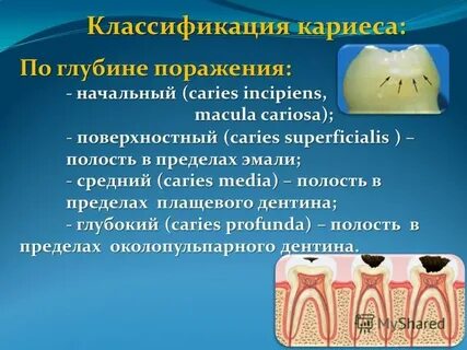 Классификация кариеса