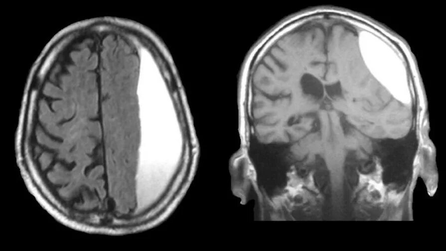 Субдуральная гематома мрт. Субдуральная гематома головного мозга мрт. Эпидуральная гематома мрт. Внутричерепная субдуральная гематома мрт. Гематома мозга операция