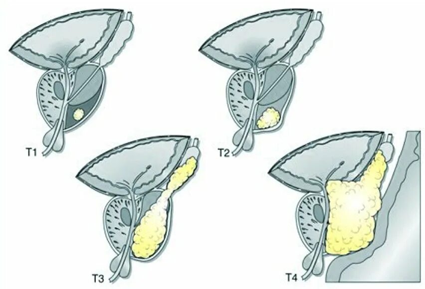 Стадии предстательной железы прогноз. TNM классификация предстательной железы. Т3а предстательной железы. Аденома предстательной железы 2 стадии. ТНМ предстательной железы.