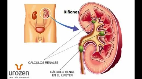 Calculos Renales - Dr. Saldaña en Ayer y Hoy - YouTube