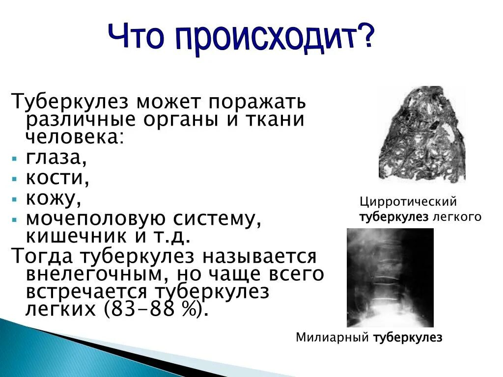 Поражаемые органы туберкулеза. Туберкулез разных органов и систем. Поражение органов туберкулезом.