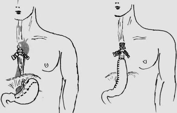 Хирургическое лечение пищевода. Операция Добромыслова-Торека схема. Операция Добромыслова-Торека пищевод.