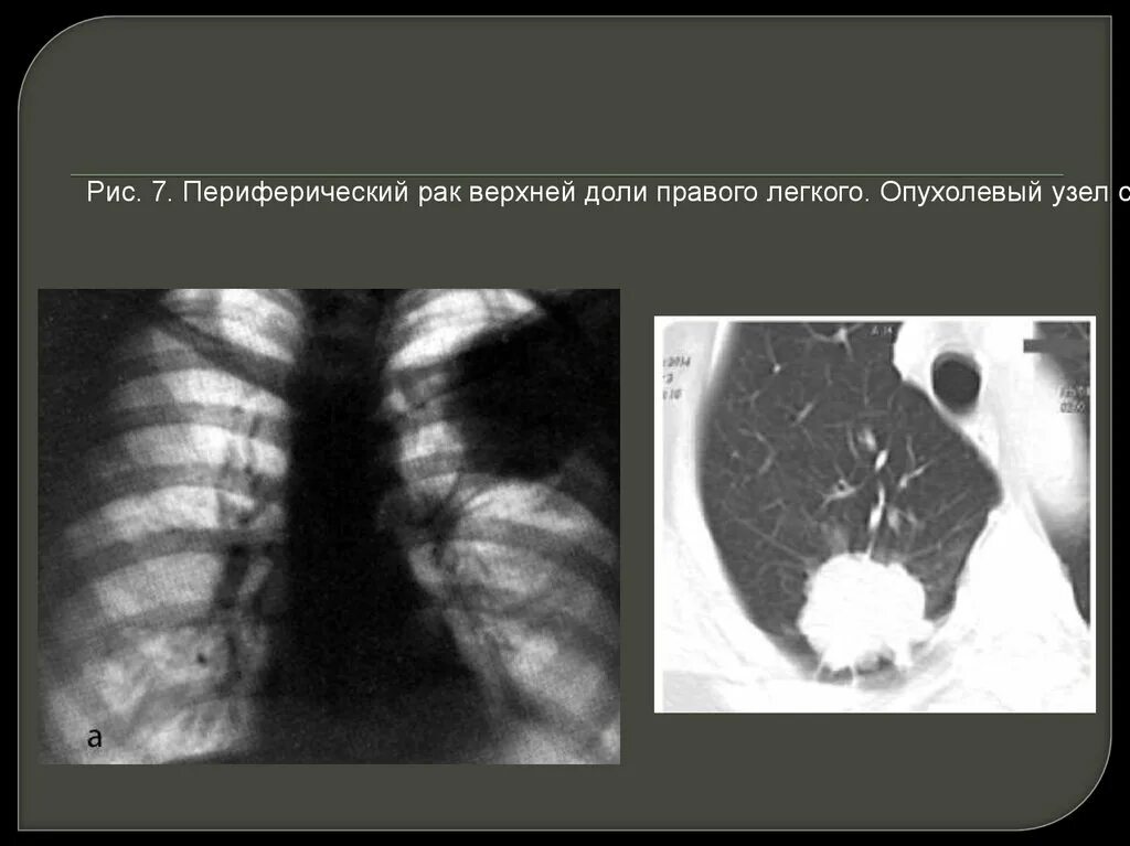 Признаки периферического легкого. Опухоль верхней доли правого легкого. Периферическое образование верхней доли правого легкого. Новообразование верхней доли правого легкого. Переферический очаг правого легкого.