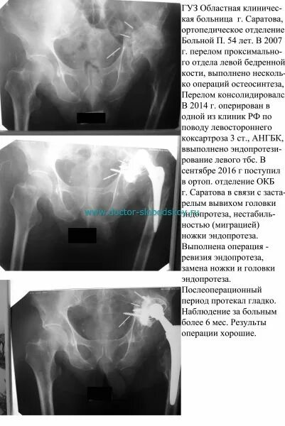 Как лечить синовит тазобедренного сустава. Вывих тазобедренного сустава рентген описание. тэп тазобедренного сустава рентген.