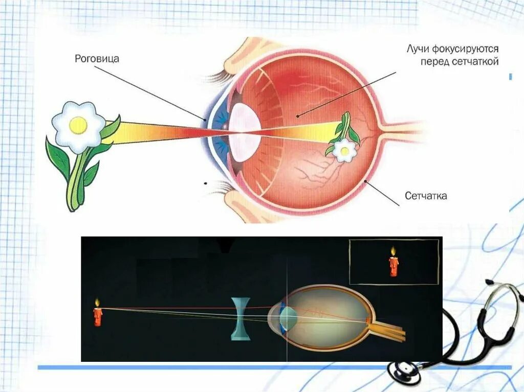 При близорукости лучи фокусируются за сетчаткой. Изображение за сетчаткой. Изображение перрд сетчатке глаза. Перед сетчаткой расположена