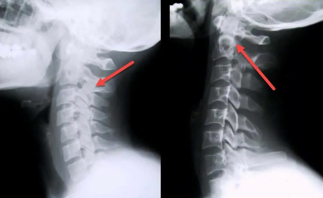 Остеохондроз грудного отдела позвоночника рентген. Остеохондроз шейного отдела на снимке рентген. Остеохондроз шейного отдела позвоночника рентген. Рентген здорового позвоночника грудного отдела.
