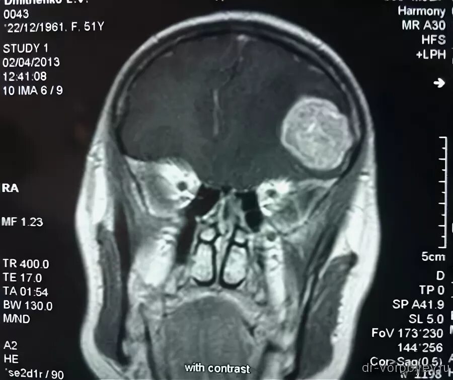 Лечение метастазов мозга. Гамма нож метастазы в головной мозг. Как выглядят метастазы в голове.