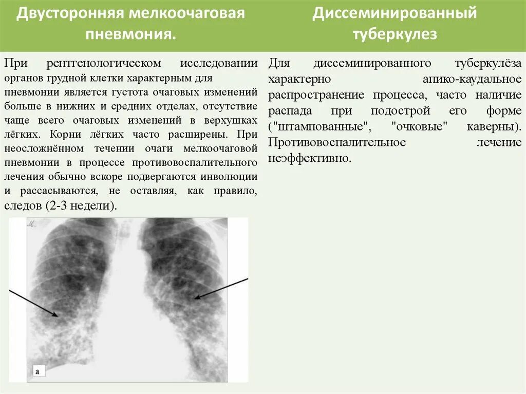 Диссеминированный туберкулез фаза инфильтрации