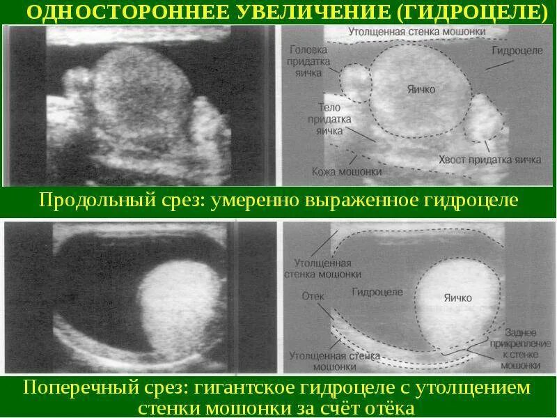 Увеличено яичко у мальчика. Водянка яичка УЗИ заключение. Гидроцеле на УЗИ протокол. Водянка УЗИ протокол. Жидкость в мошонке по УЗИ.