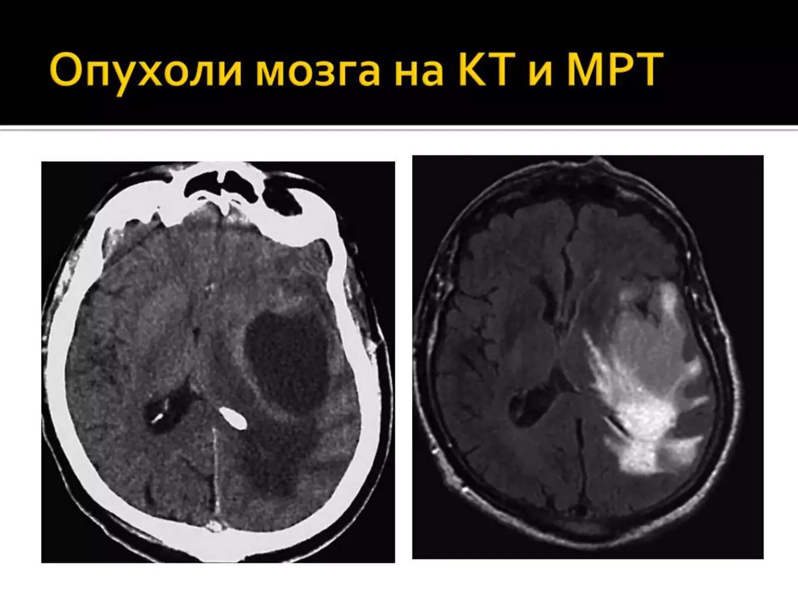 Опухоль головного глиома кт. Злокачественная опухоль головного мозга на кт. Опухоли головного мозга мрт глиома. Кт и мрт при опухолях мозга. Опухоль головного мозга отек