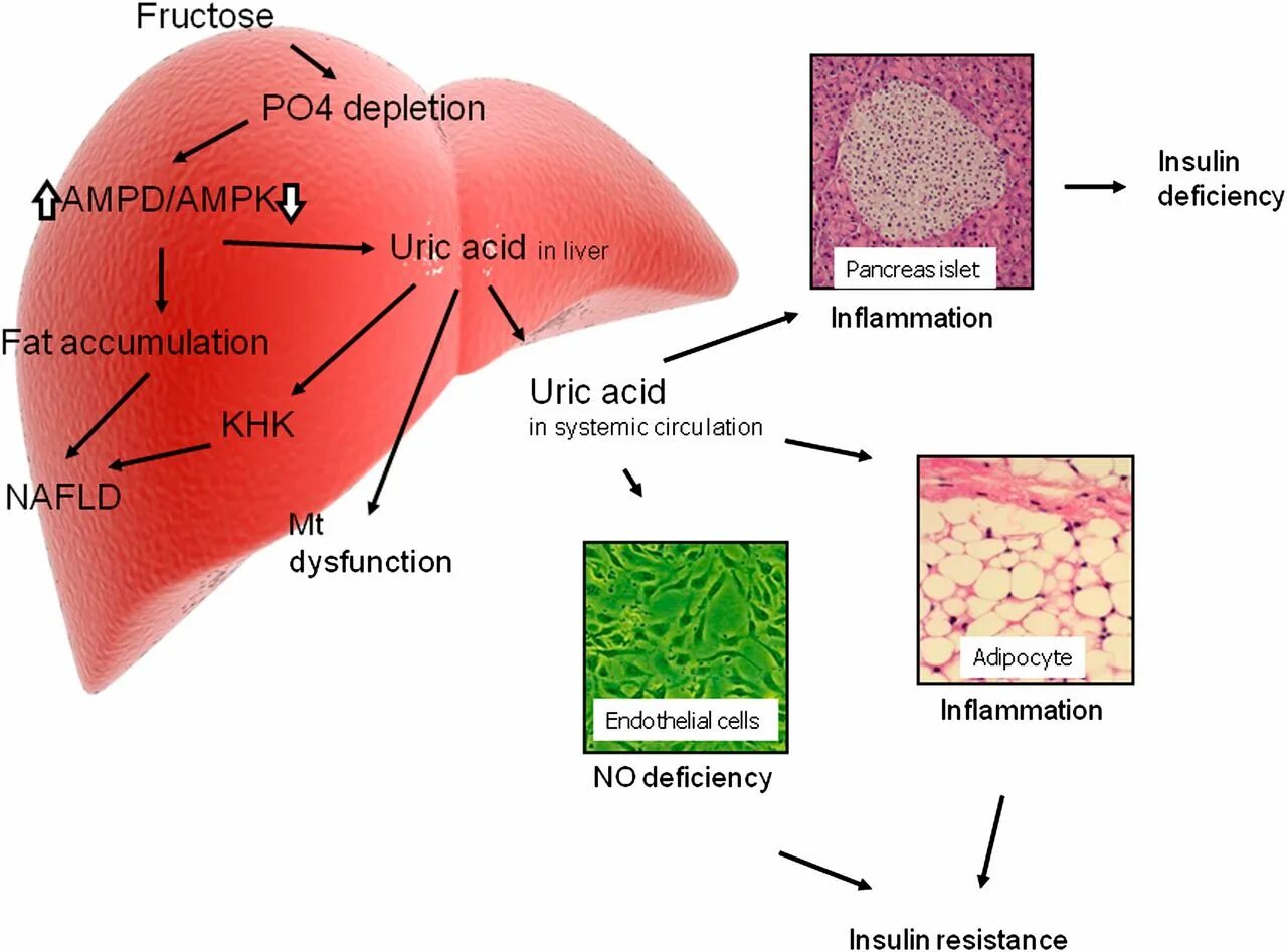 Фруктоза влияние на печень. Инсулин в печени. Инсулин и мочевая кислота. Фруктоза и печень