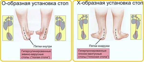 Пятки внутрь. Вальгусная и варусная деформация. Вальгусная деформация голеностопного сустава. Варусная деформация стопы. Варусная деформация пальцев стопы.