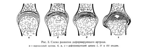 Деформирующий 2 степени