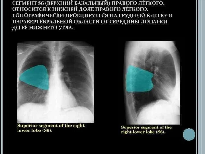 S6 в легких в правом легком. S6 легкое сегмент. Сегменты верхней доли правого лёгкого. Сегмент s7 правого легкого. Сегмент s6 правого легкого на кт.